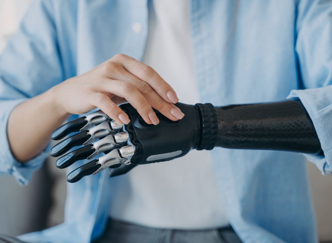 Bioninen raajaproteesi naisoletetun kädessä. 